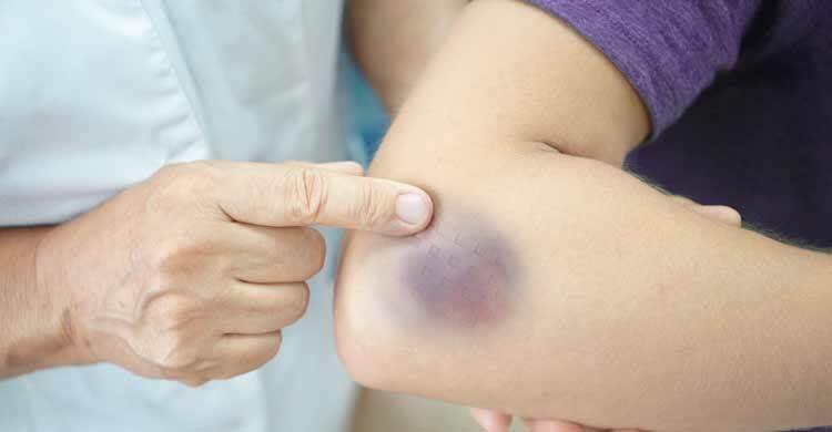 সামান্য আঘাতেই ত্বকে কালশিটে দাগ পড়া কীসের ইঙ্গিত?