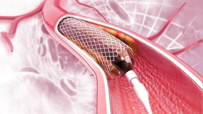 অবশেষে ২৩ ধরনের হার্টের রিংয়ের দাম কমলো