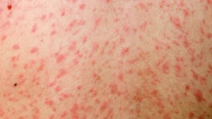 হামে আরও ৪ জনের প্রাণহানি, নতুন শনাক্ত ৬৮৫