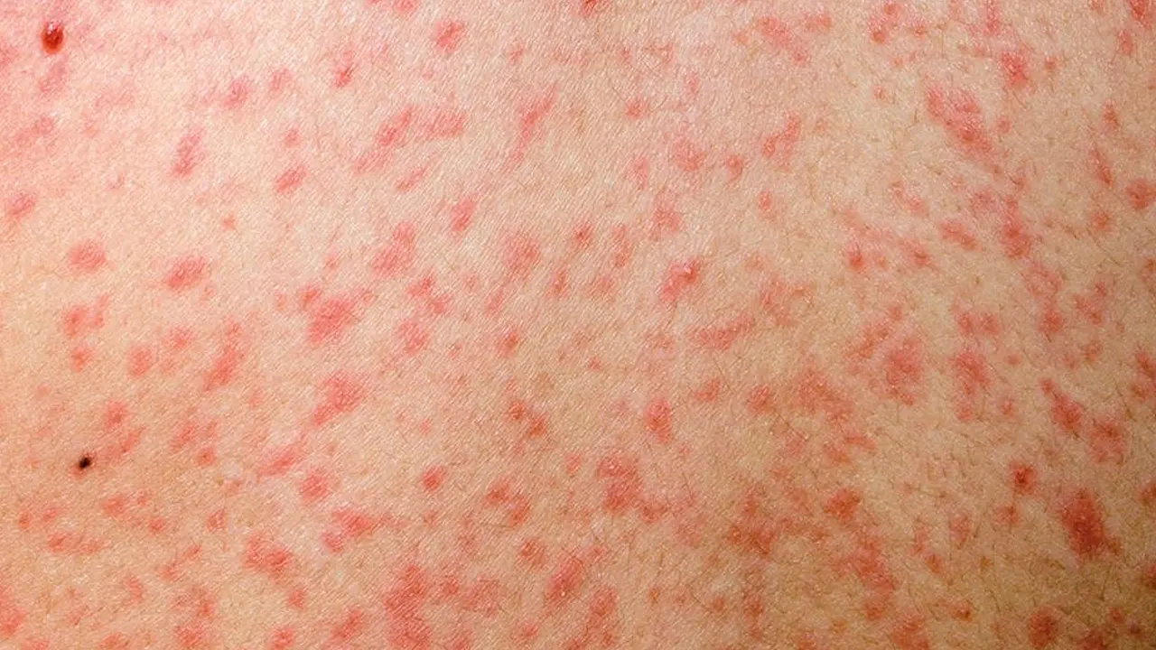 হামে আরও ৪ জনের প্রাণহানি, নতুন শনাক্ত ৬৮৫